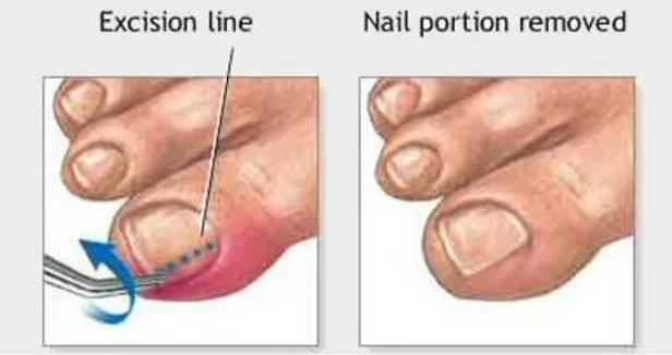 What Is The Fastest Way To Get Rid Of An Ingrown Toenail? Toe nail