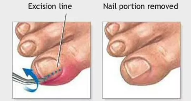 Ingrown Toenail Removal Treatment Toronto Laser Nail